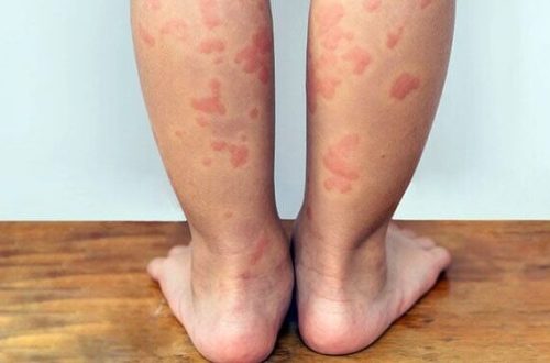 urticaria-omnicure-research